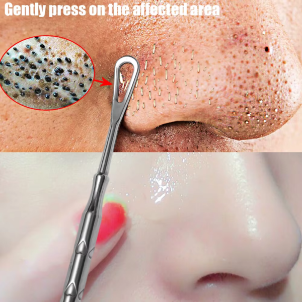 Blackhead Remover Tool – Acne & Pimple Extraction Kit - Image 5